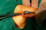 ばね指手術、腱鞘炎 整形外科 岐阜市 リハビリテーション