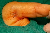 ばね指手術、腱鞘炎 　外科整形外科　 岐阜市 　リハビリテーション