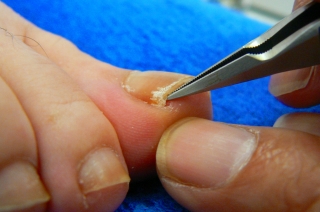 巻爪　陥入爪の治療　外科 整形外科 岐阜市 リハビリテーション