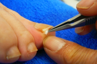 巻爪　陥入爪の治療　外科 整形外科 岐阜市 リハビリテーション