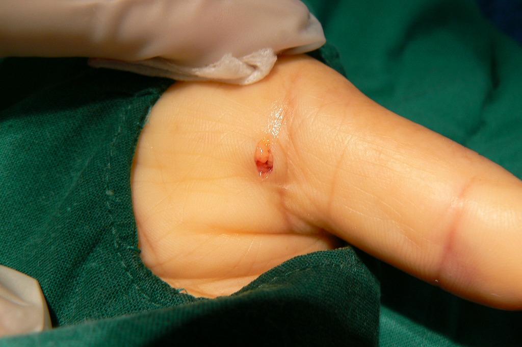 ばね指　腱鞘炎の治療　岐阜市　外科 整形外科  リハビリテーション