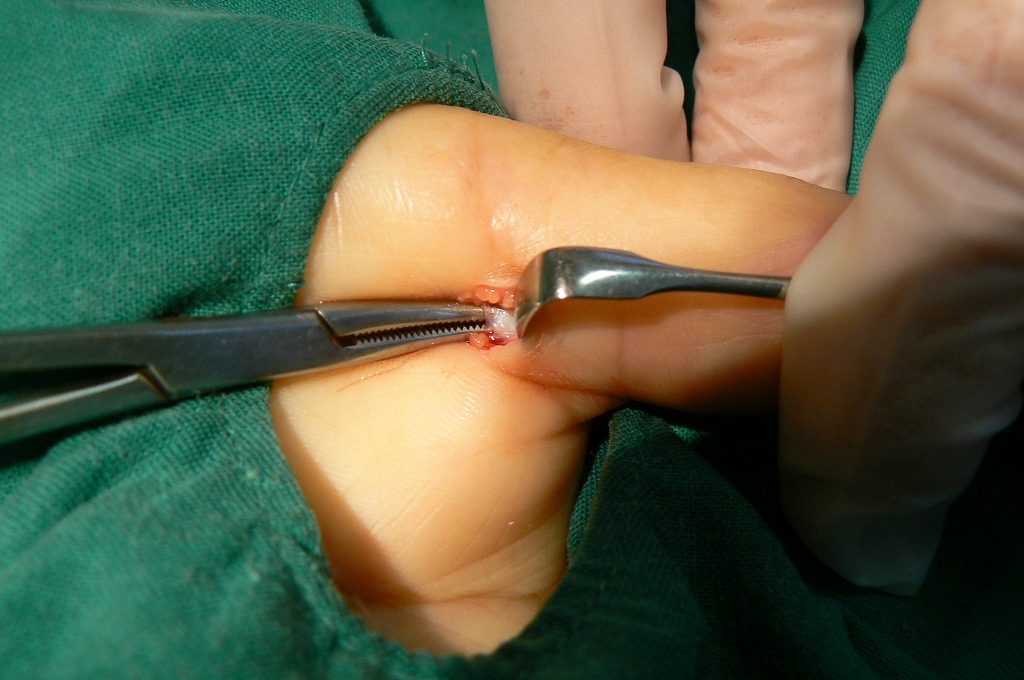 ばね指　腱鞘炎の治療　岐阜市　外科 整形外科  リハビリテーション