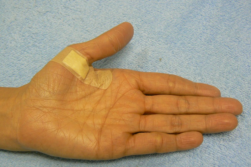 ばね指　腱鞘炎の治療　岐阜市　外科 整形外科 　リハビリテーション